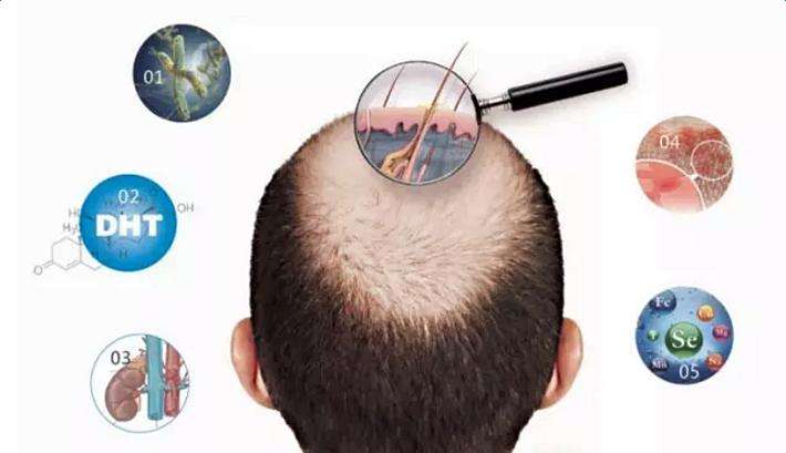 病理性脱发是指头发异常或过度的脱落,病理性脱发的主要原因是人体